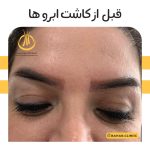 نمونه کاشت ابرو کلینیک بهار
