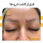 نمونه کاشت ابرو