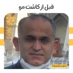 نمونه کاشت مو