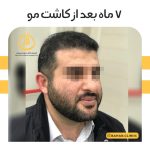 نمونه کاشت مو