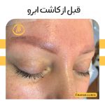 نمونه کاشت ابرو