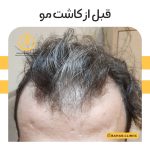 نمونه کاشت مو