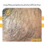 نمونه کاشت مو کلینیک بهار