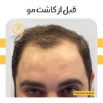 نمونه کاشت مو کلینیک بهار