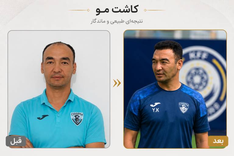 نمونه کاشت مو در گرگان - قبل و بعد